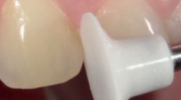 Cas pratique lentille