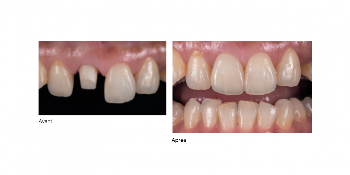 Disque ZR Lucent Supra - CAD-CAM et numérique - Prothèse - SDC